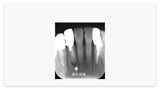 再根管治療（感染根管処置）
