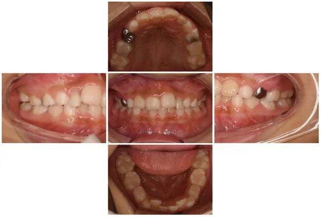 CASE①：小児矯正 Before